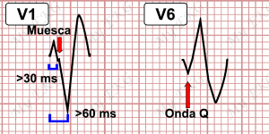 Orejas de conejo en un ECG